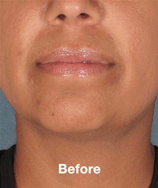kybella before & after photo
