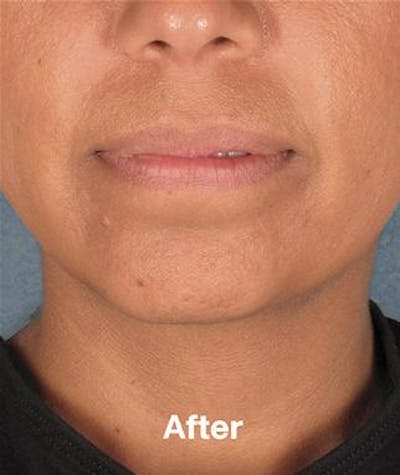 before & after kybella
