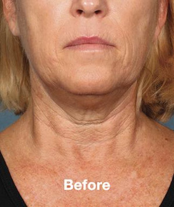 before and after kybella