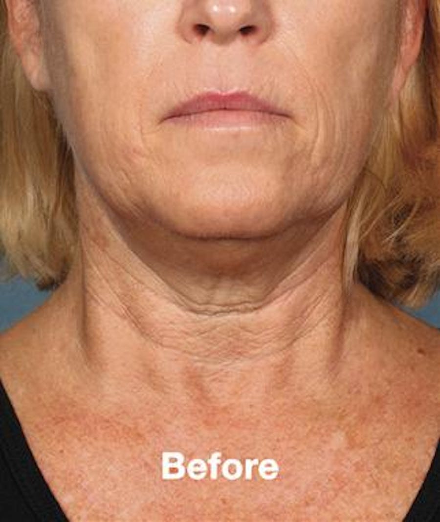 before and after kybella