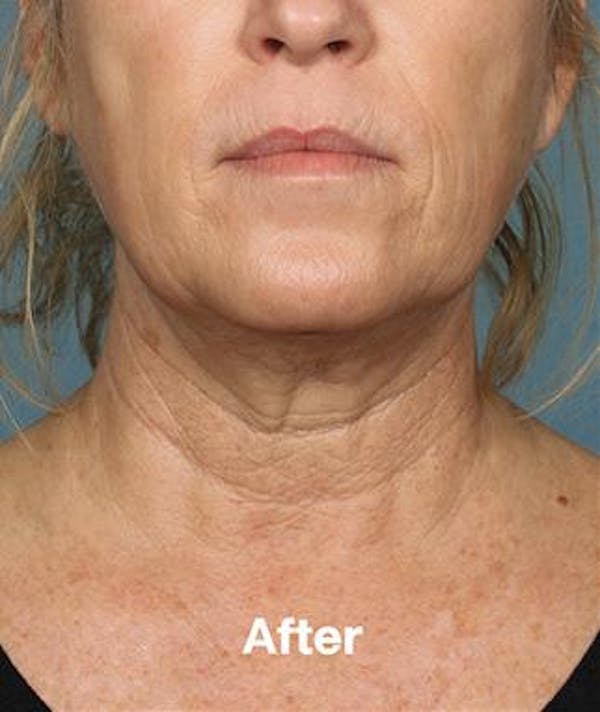 results from kybella