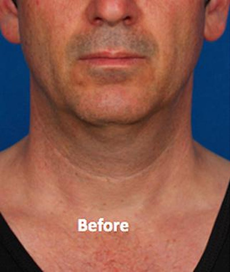 kybella paitent before and after