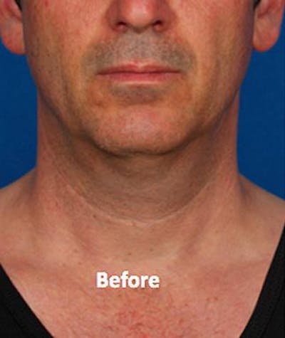 kybella paitent before and after
