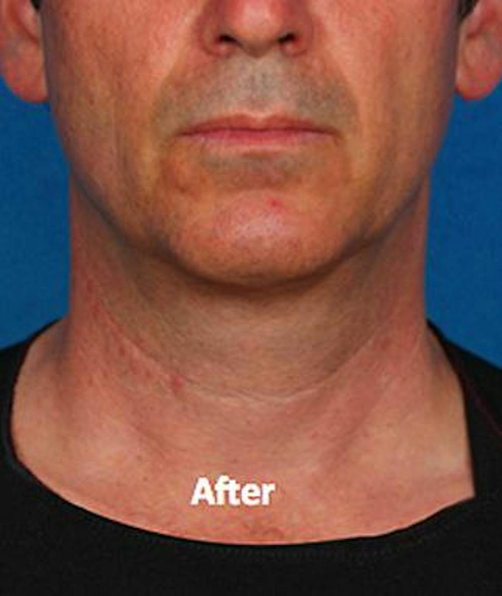 kybella before & after