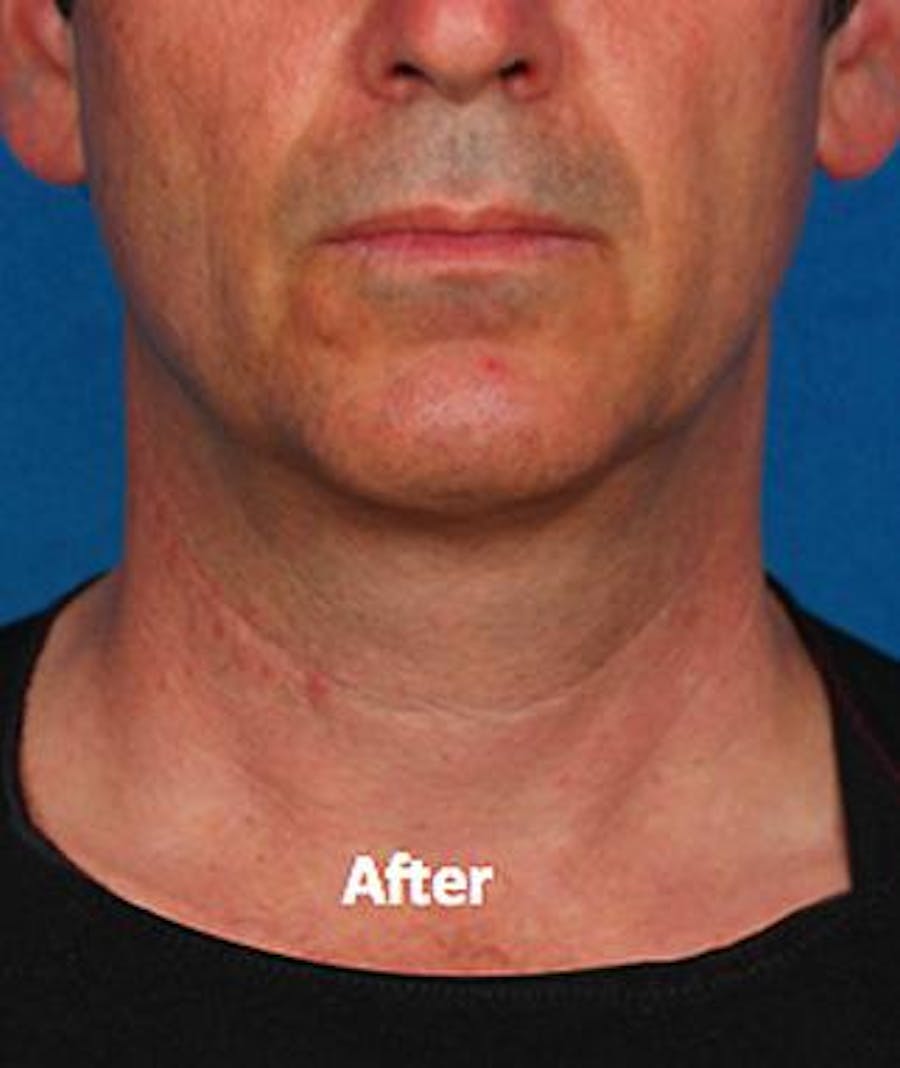 kybella before & after