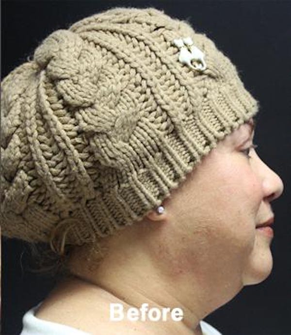 kybella before & after