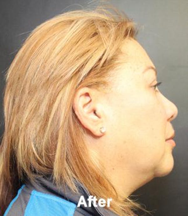 before and after kybella