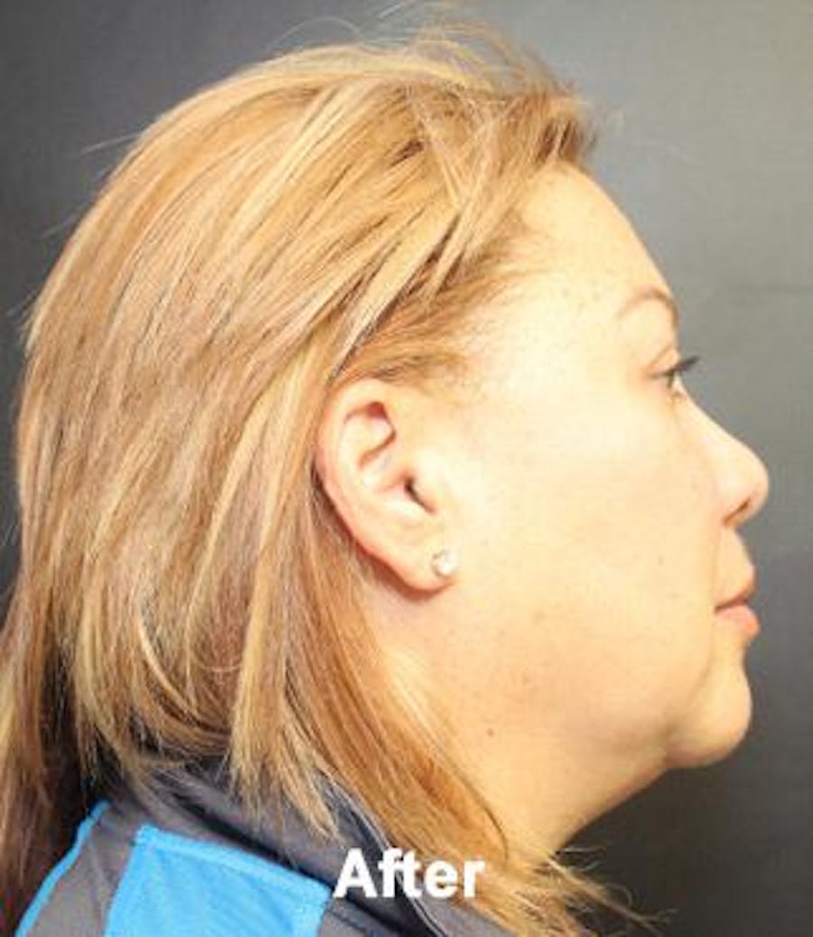 before and after kybella