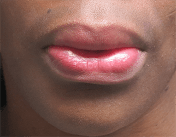 Lip Reduction Before & After Gallery - Patient 25274177 - Image 1