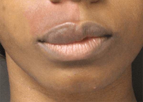 Lip Reduction Before & After Gallery - Patient 25274179 - Image 1