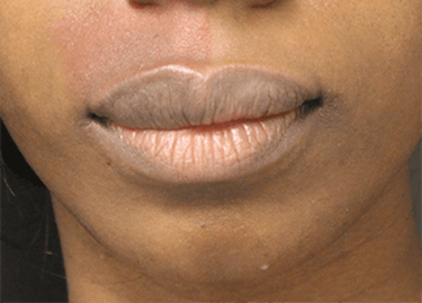 Lip Reduction Before & After Gallery - Patient 25274179 - Image 2