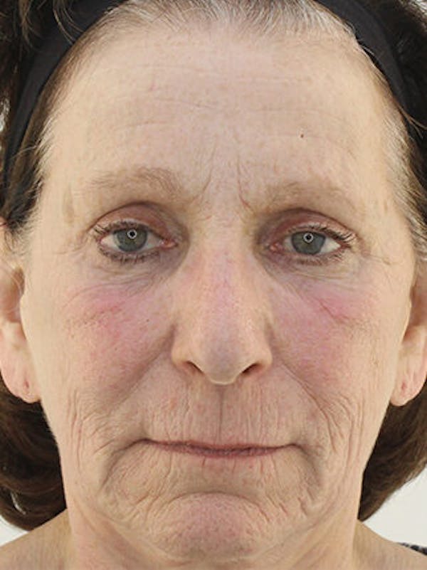 Facial Fat Grafting Before & After Gallery - Patient 25274183 - Image 1