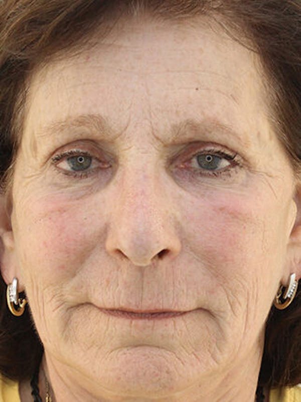 Facial Fat Grafting Before & After Gallery - Patient 25274183 - Image 2