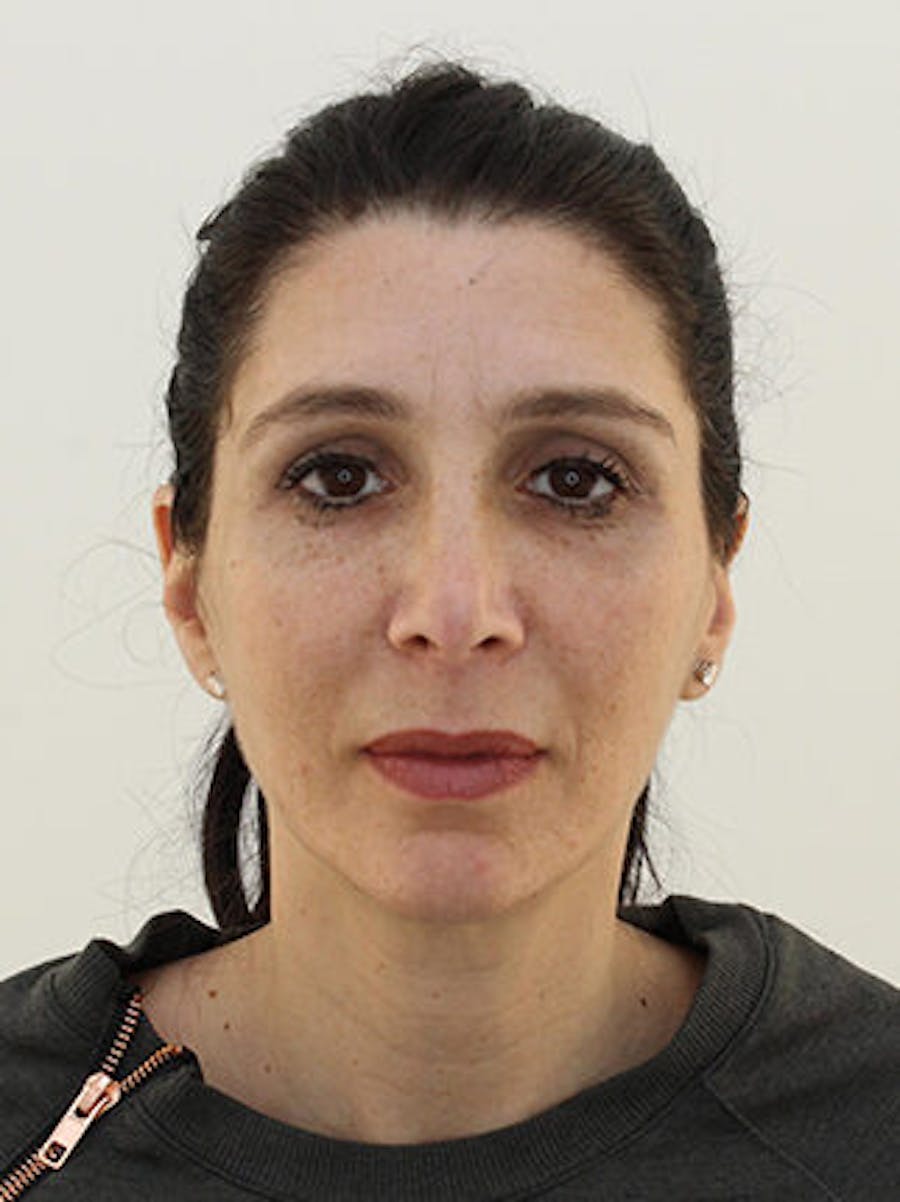 Facial Fat Grafting Before & After Gallery - Patient 25274193 - Image 2