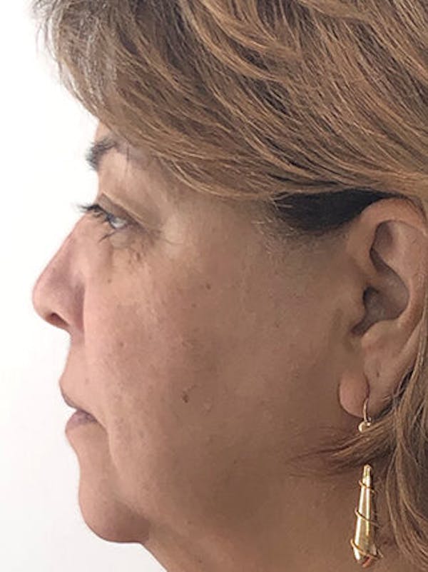 Facial Fat Grafting Before & After Gallery - Patient 25274195 - Image 1