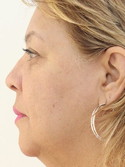 Facial Fat Grafting Before & After Gallery - Patient 25274195 - Image 2