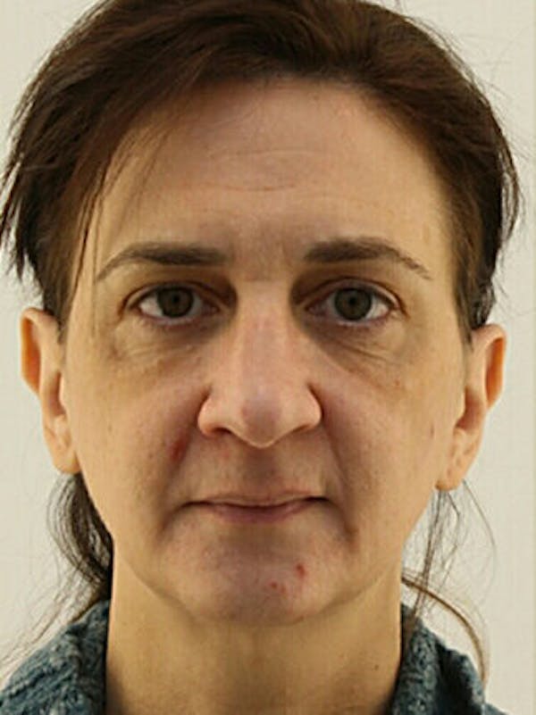 Facial Fat Grafting Before & After Gallery - Patient 25274199 - Image 1