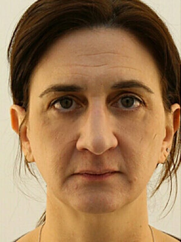 Facial Fat Grafting Before & After Gallery - Patient 25274199 - Image 2