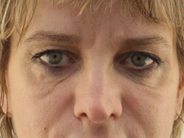  Blepharoplasty Before & After Gallery - Patient 25274624 - Image 1