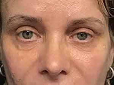  Blepharoplasty Before & After Gallery - Patient 25274624 - Image 2