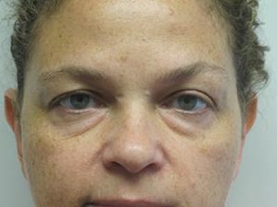  Blepharoplasty Before & After Gallery - Patient 25274627 - Image 1