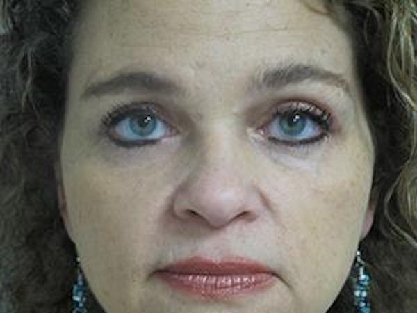  Blepharoplasty Before & After Gallery - Patient 25274627 - Image 2