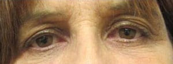  Blepharoplasty Before & After Gallery - Patient 25274630 - Image 1