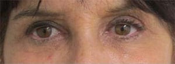  Blepharoplasty Before & After Gallery - Patient 25274630 - Image 2
