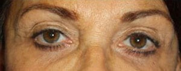  Blepharoplasty Before & After Gallery - Patient 25274632 - Image 1