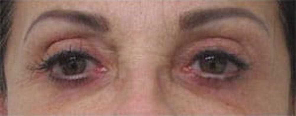  Blepharoplasty Before & After Gallery - Patient 25274632 - Image 2