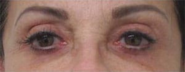 Blepharoplasty Before & After Gallery - Patient 25274632 - Image 2