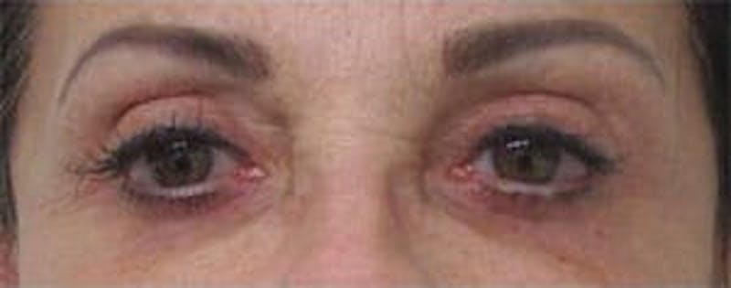  Blepharoplasty Before & After Gallery - Patient 25274632 - Image 2