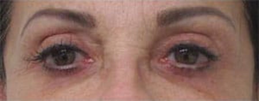  Blepharoplasty Before & After Gallery - Patient 25274632 - Image 2