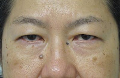 Before and After Blepharoplasty in NYC 03