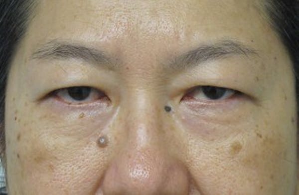 Blepharoplasty Before & After Gallery - Patient 25274638 - Image 1