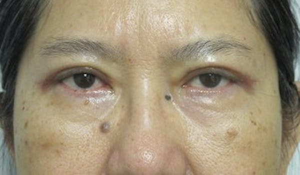  Blepharoplasty Before & After Gallery - Patient 25274638 - Image 2