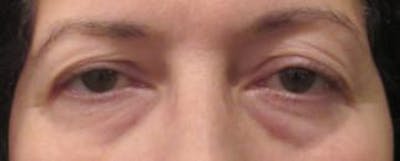 Before and After Eyelid Surgery in Weschester 04