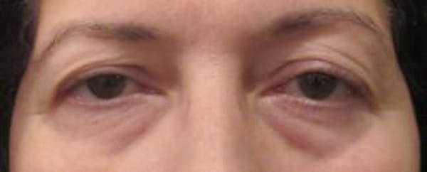  Blepharoplasty Before & After Gallery - Patient 25274639 - Image 1