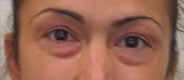  Blepharoplasty Before & After Gallery - Patient 25274642 - Image 1