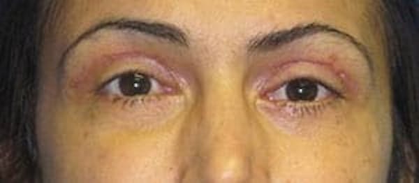  Blepharoplasty Before & After Gallery - Patient 25274642 - Image 2