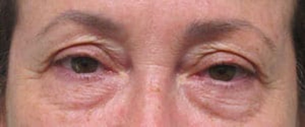  Blepharoplasty Before & After Gallery - Patient 25274643 - Image 1