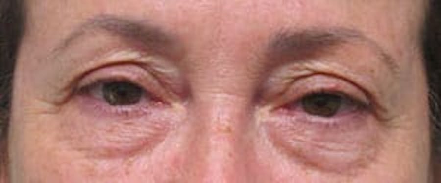  Blepharoplasty Before & After Gallery - Patient 25274643 - Image 1