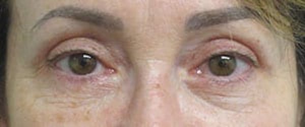  Blepharoplasty Before & After Gallery - Patient 25274643 - Image 2