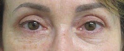 Before and After Blepharoplasty in NYC 05