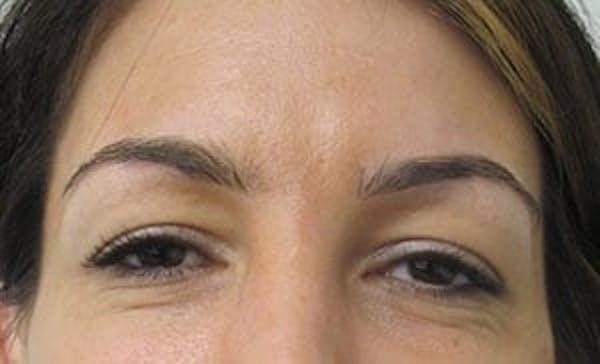  Blepharoplasty Before & After Gallery - Patient 25274646 - Image 1