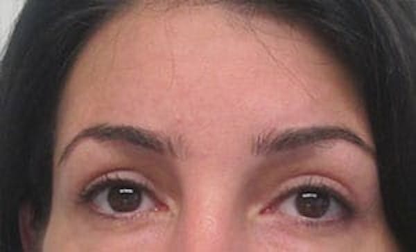  Blepharoplasty Before & After Gallery - Patient 25274646 - Image 2