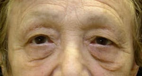  Blepharoplasty Before & After Gallery - Patient 25274648 - Image 1
