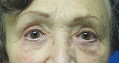  Blepharoplasty Before & After Gallery - Patient 25274648 - Image 2
