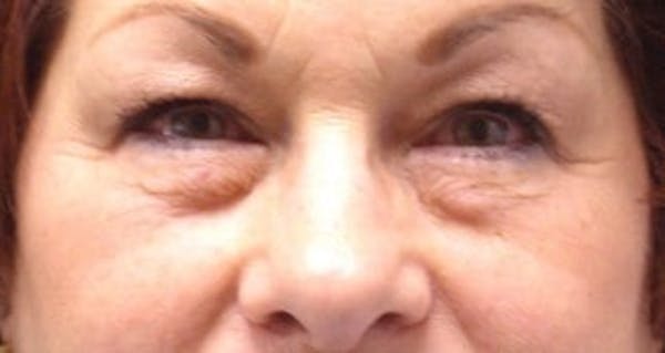  Blepharoplasty Before & After Gallery - Patient 25274650 - Image 1