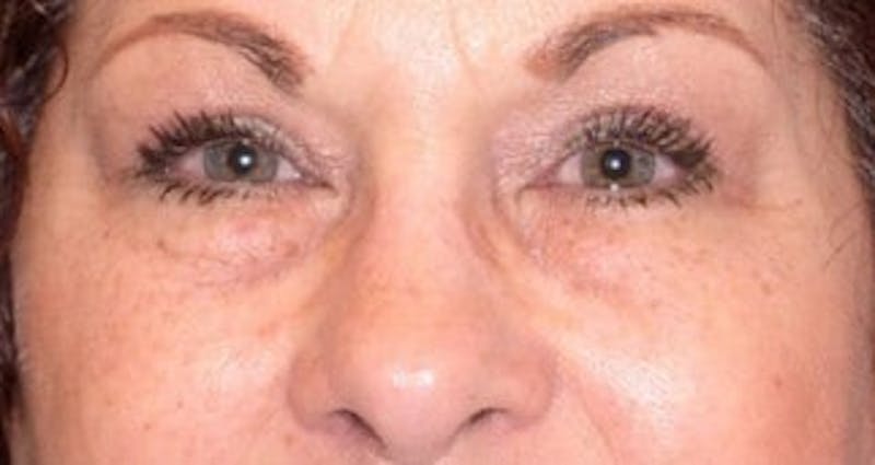  Blepharoplasty Before & After Gallery - Patient 25274650 - Image 2